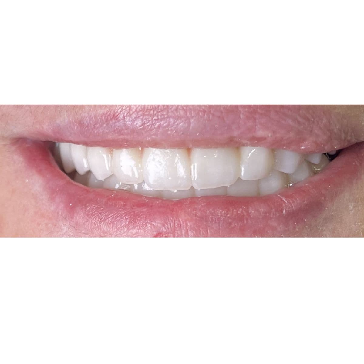 صورة بعد العلاج لحالة تعويض الأسنان المفقودة